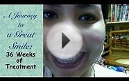 A Journey to a Great Smile: 36 Weeks of treatment